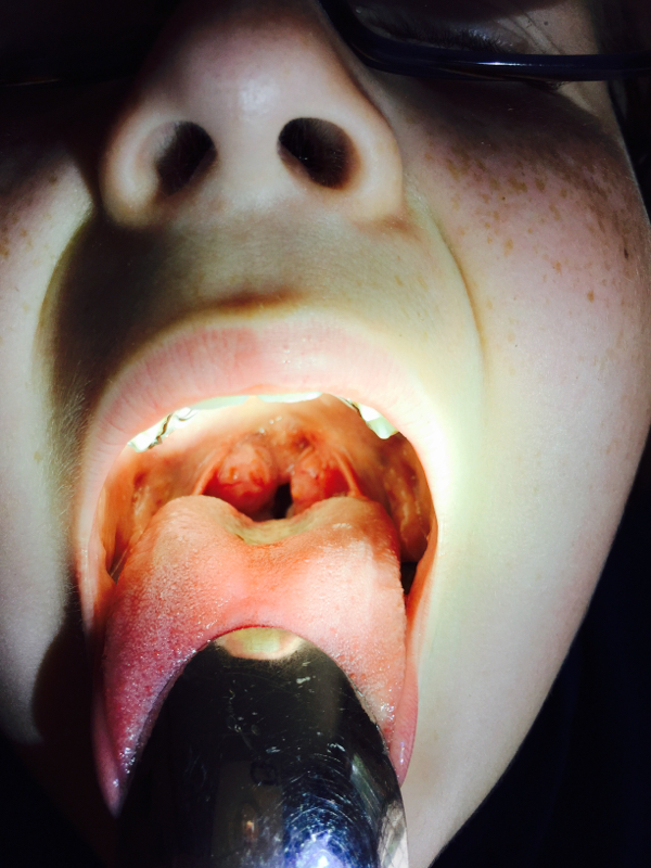 Tonsils (WARNING: graphic tonsil pics:) - Chickens, bees & our life